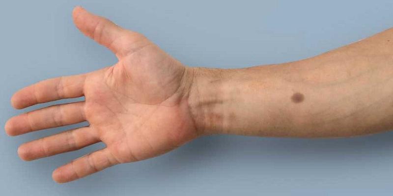 Uma tatuagem em forma de pinta pode detectar sinais de câncer-0